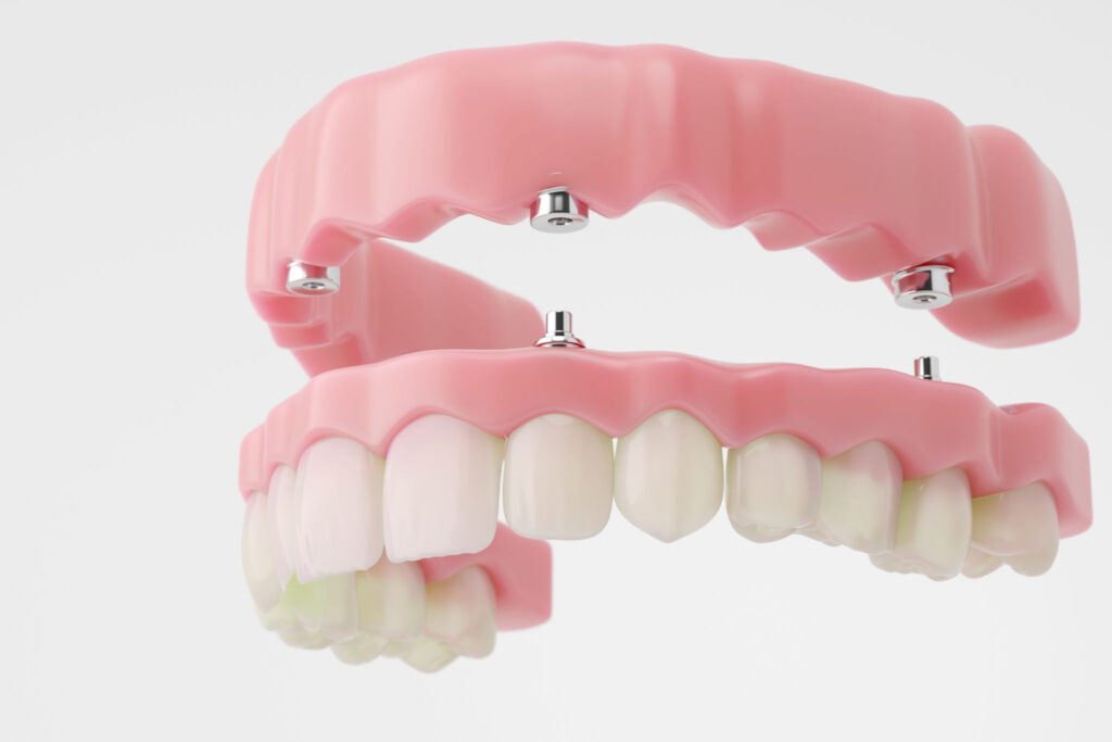 3D illustration of an all-on-4 dental implant system showing the fixed prosthetic bridge attached to four implants at Dental Clinic 24 Antalya.