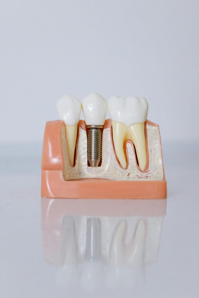 A detailed cross-section model of a dental implant placed between natural teeth, showing the screw and crown structure at Dental Clinic 24 Antalya.