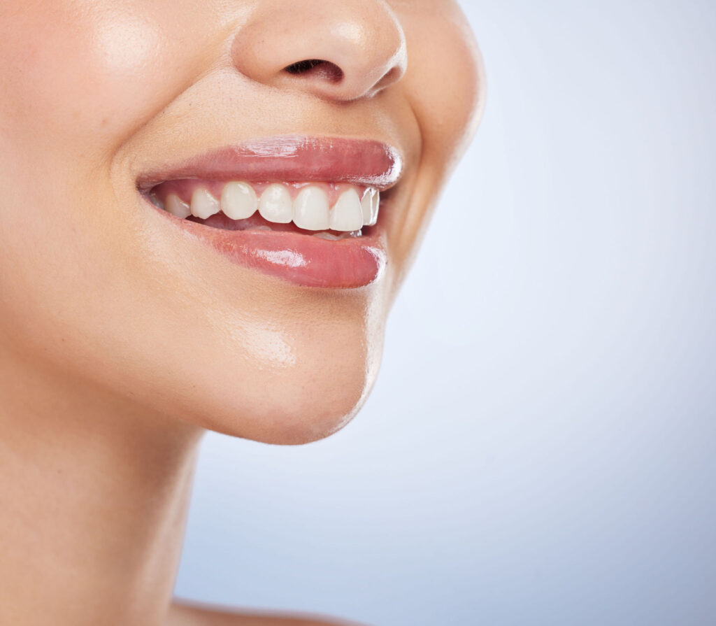 Close-up of a woman's perfect white smile after a successful cosmetic dental treatment at Dental Clinic 24 Antalya.