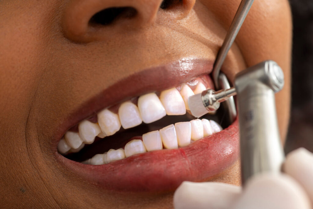 Close-up of a professional teeth cleaning and polishing procedure using a dental handpiece at Dental Clinic 24 Antalya.